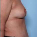 Mommy Makeover Before & After Patient #34313